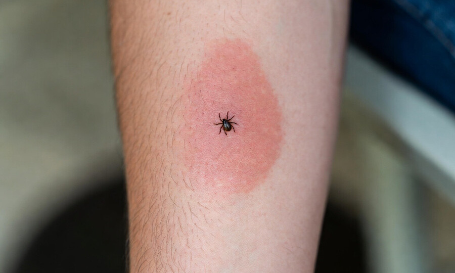 КЛЕЩИ НАЧАЛИ КУСАТЬ